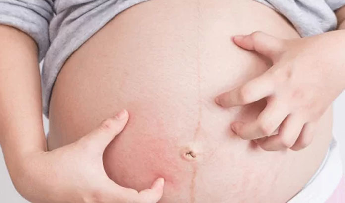 hamilelikte alerji neden olur ve nasıl geçer